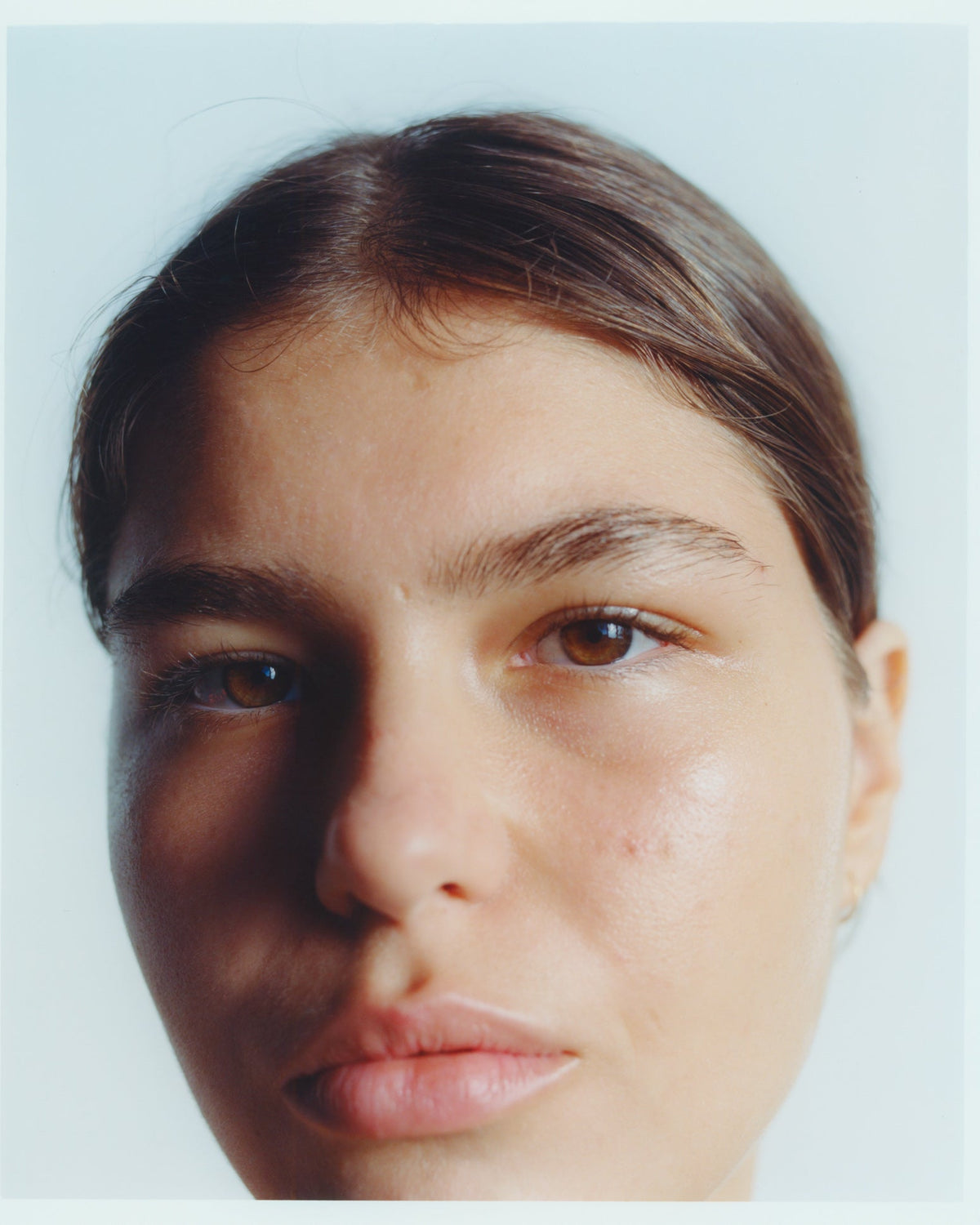 Treating Rosacea - Your Holistic Guide